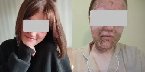 В Гродно девочка получила химический ожог лица после использования косметической пудры